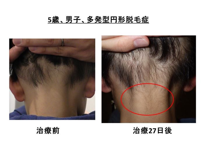 円形脱毛症　病院